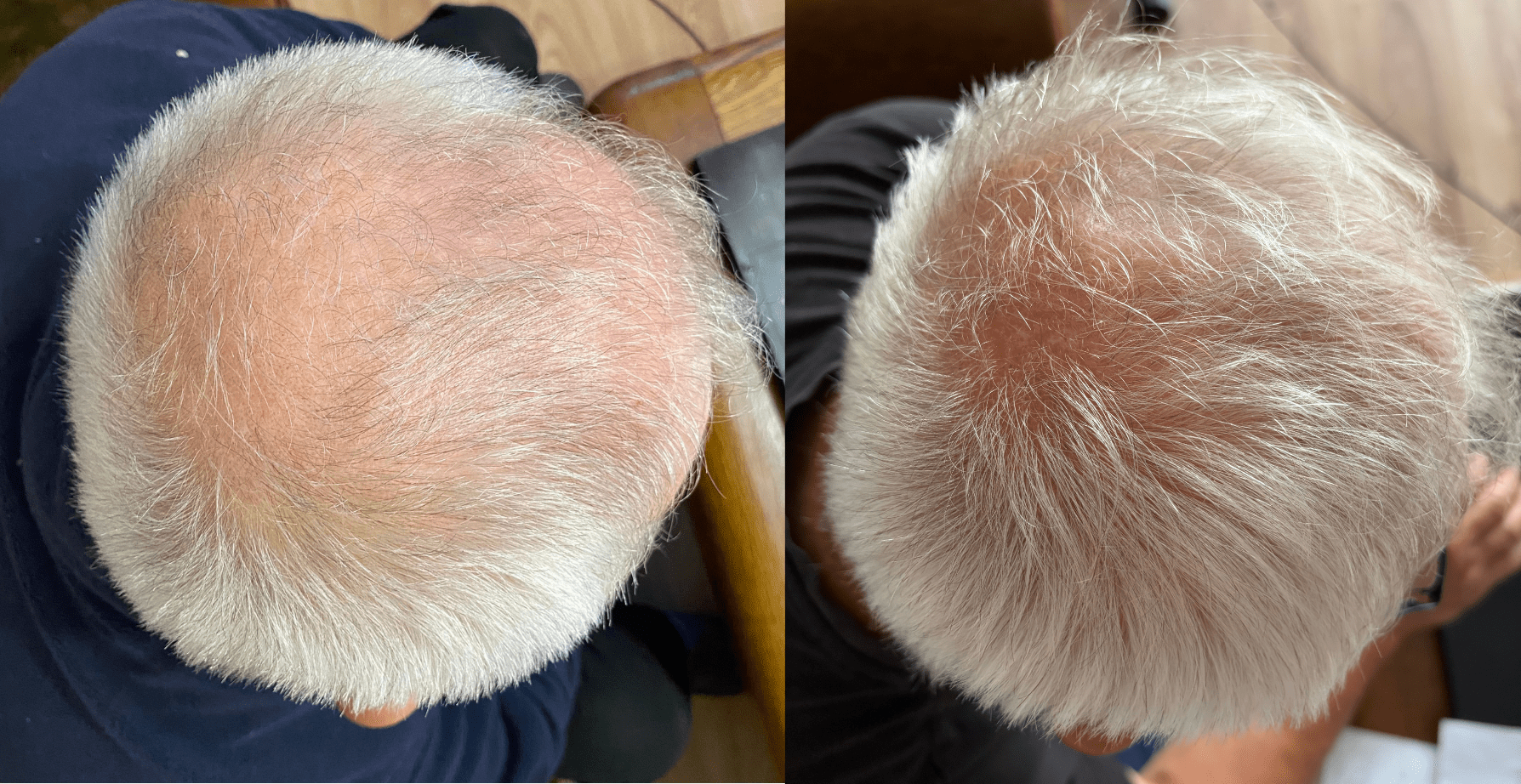annemarie test CurrentBody LED hair growth helmet discount code ANNEMARIECB